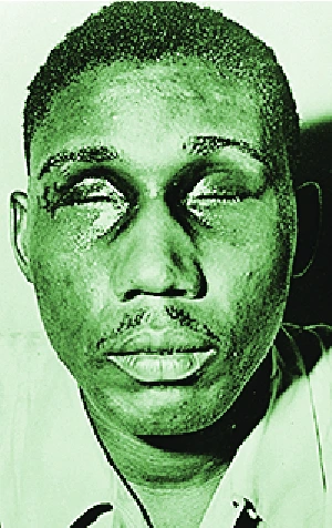 Isaac Woodard with eyes swollen shut from aggravated assault and blinding.